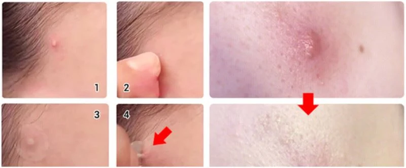 microneedle Acne patch microneedle Acne patch